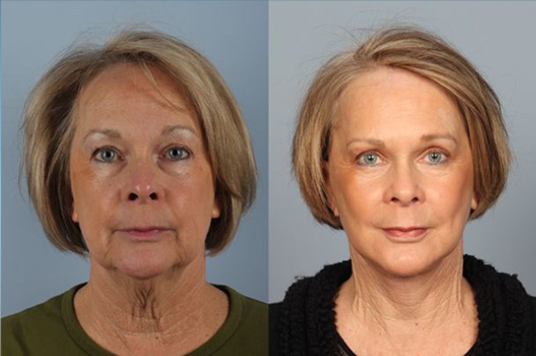 Facelift And Neck Lift Before And After Raval Facial Aesthetics Denver